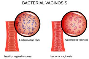 Бактеріальний вагіноз і безпліддя