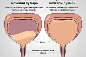 Гіперактивний сечовий міхур у чоловіків
