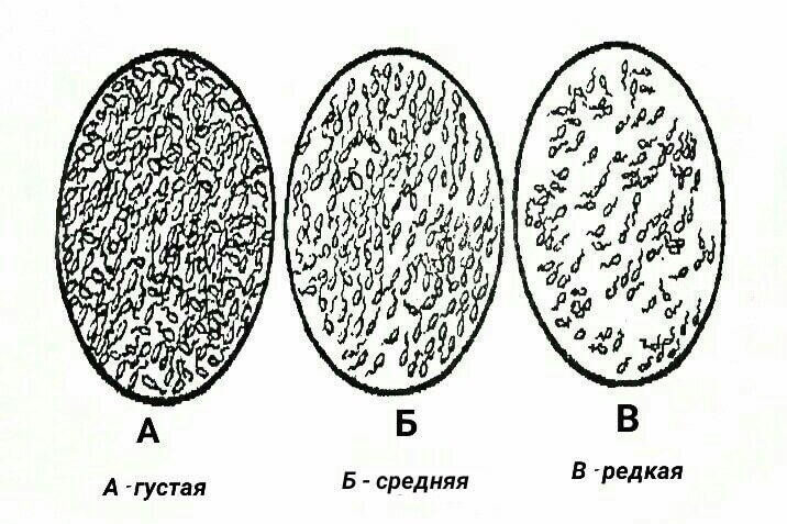 Гипоспермия: что это? Лечение, причины и симптомы заболевания